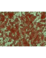 Human Preadipocytes-visceral (HPA-v) - Intracellular lipid droplets are visible after differentiation by Oil Red O staining, 400x.