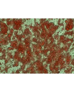 Human Preadipocytes-visceral (HPA-v) - Intracellular lipid droplets are visible after differentiation by Oil Red O staining, 400x.
