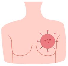 breastcancer